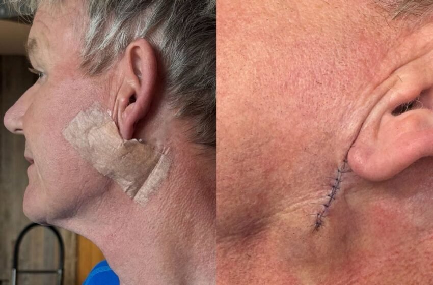  Wajah Berjahit, Gordon Ramsay Syukur Pembedahan Kanser Kulit Berjaya