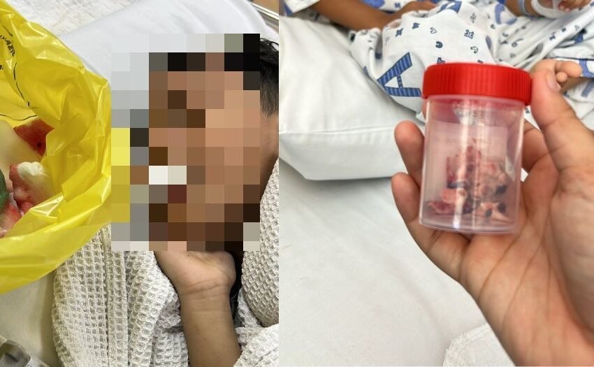  Gara-Gara Tak Jaga Kebersihan Mulut, 12 Batang Gigi Kanak-Kanak Ini Dicabut Serentak